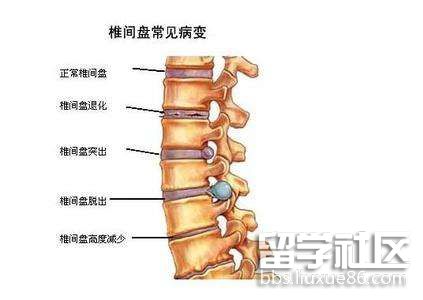 腰椎间盘突出症的治疗方法.jpg